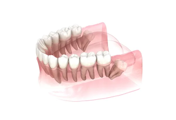 Traditional Surgical tooth Extraction